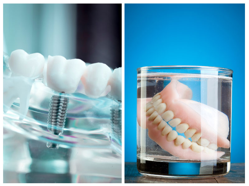 Implants Dentures
