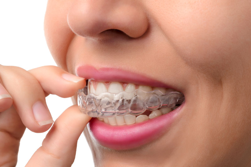 Invisalign in Casuarina NT  Benefits of Invisible Braces