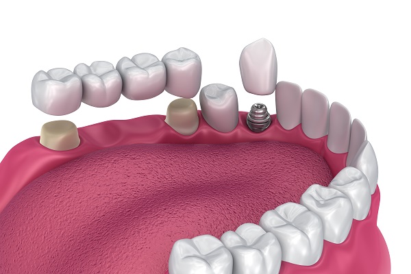 Dental Bridge