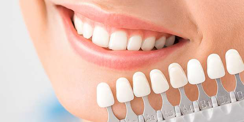 Dental Veneers and Dental Laminates
